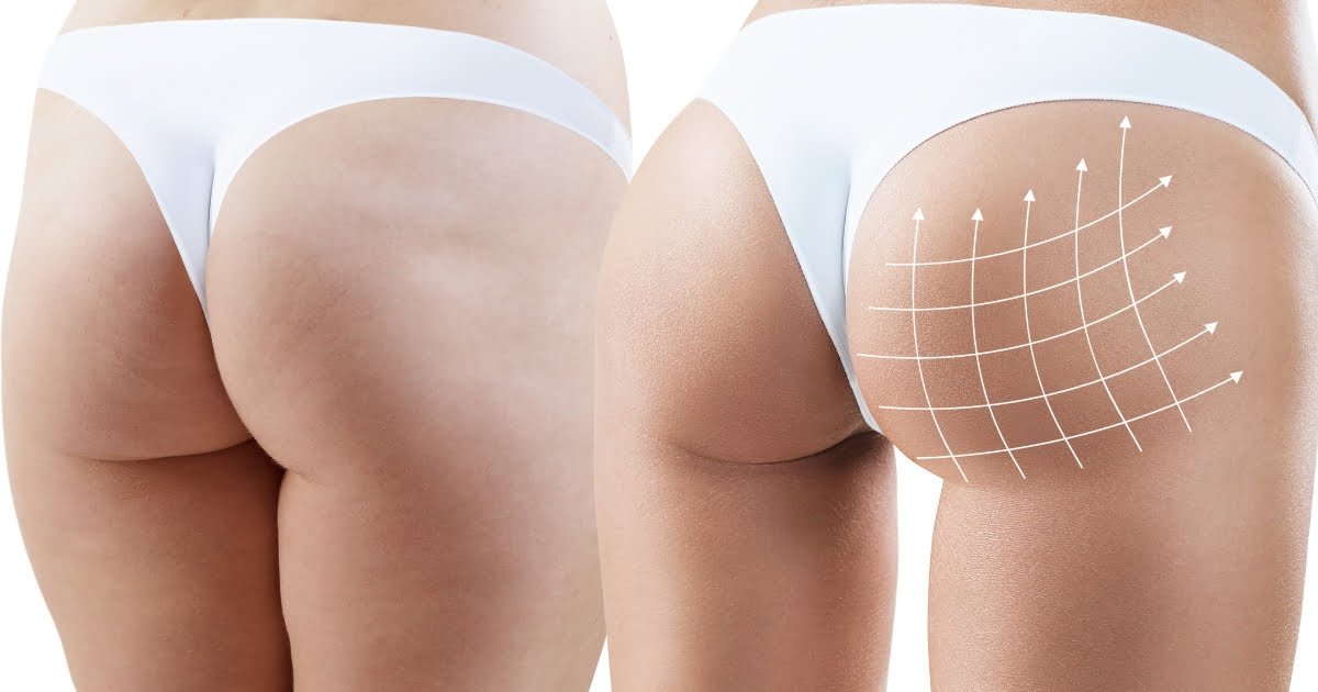 brazilian buttlift inngrep